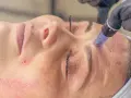 Skóra po mezoterapii mikroigłowej zaczerwieniona, z widocznymi drobnymi nakłuciami. Możliwe mezoterapia mikroigłowa efekty uboczne.