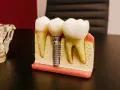 Model szczęki z zębami i mikroimplantem ortodontycznym. Implant zastępuje korzeń zęba, zapewniając stabilne podparcie dla korony.