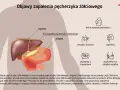 Anatomia człowieka z zaznaczonym pęcherzykiem żółciowym i objawami jego zapalenia: ból, wzdęcia, wymioty, problemy z trawieniem.