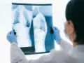Lekarz w niebieskich rękawiczkach analizuje RTG klatki piersiowej i kręgosłupa, szukając oznak osteoporozy.