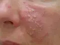 Rötungen im Gesicht: Was hilft wirklich gegen Couperose & Rosazea?