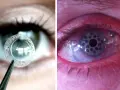 Lente per trapianto di retina in fase di applicazione e occhio con impianto retinico.