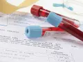 Próbki krwi w probówkach leżą na wynikach badań, gdzie widnieje m.in. poziom cholesterolu LDL. Wyniki mogą wskazywać na potrzebę monitorowania białka c reaktywnego.