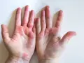 Manos con dishidrosis, mostrando piel enrojecida, seca y agrietada en palmas y dedos.
