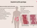 Zapalenie jelita grubego: objawy przewlekłe (biegunka, zaparcia, wzdęcia, bóle brzucha) i ostre (obfita biegunka, krew w kale, gorączka).