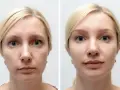 Przed i po zabiegu PRP: skóra twarzy kobiety wygładzona, zmarszczki zredukowane, cera promienna.