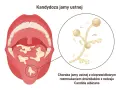 Kandydoza jamy ustnej: białe naloty na języku i podniebieniu, powiększone drożdżaki Candida. Objawy mogą być niepokojące.