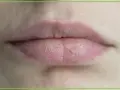 Zbliżenie na usta z widocznymi pęknięciami i suchą skórką. Potrzeba nawilżenia, by pozbyć się uczucia suchych ust.