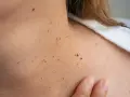 Primer plano de la piel del cuello con numerosas verrugas y lunares. Una mano toca suavemente la piel.