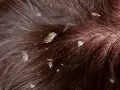 Primer plano de cabello castaño con descamación en el cuero cabelludo, mostrando escamas blancas y amarillentas entre los mechones.