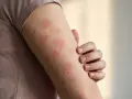 Arm mit roten Flecken auf der Haut, die auf eine allergische Reaktion oder Hautirritation hindeuten.