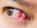 Occhio con pterigio arrossato e infiammato, in attesa di un intervento laser per rimuoverlo.