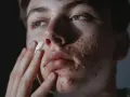 Młoda osoba z trądzikiem nakłada krem na twarz, zastanawiając się, czy sudocrem jest dobry na rany.