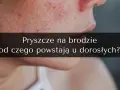 Pryszcze na brodzie: Jak się ich pozbyć? Kompletny poradnik ekspertki