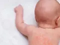Czerwone kropki na plecach i karku maluszka to potówki u niemowlaka. Skóra jest lekko zaczerwieniona.