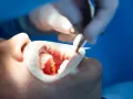 Dentysta wykonuje leczenie kanałowe zęba, używając narzędzi do precyzyjnej pracy w jamie ustnej pacjenta.