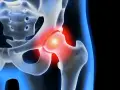 Coxarthrose Symptome: So erkennen Sie die schmerzhaften Anzeichen