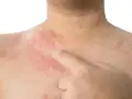 Czerwone pręgi na skórze, wynikające z dermografizmu. Co to jest? Reakcja na dotyk.