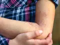 Wysypka jak ugryzienie komara u dziecka? Pokrzywka, alergia, Skeeter