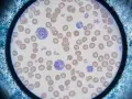 Widok pod mikroskopem: czerwone krwinki, płytki krwi i kilka białych krwinek, w tym **retikulocyty**, otoczone mroźnymi kryształkami.