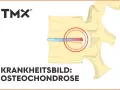 Darstellung eines Wirbels mit Bandscheibenschaden. Bei Osteochondrose wie geht es weiter? TMX Logo.