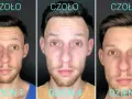 Przed i po baby botox na czole. Widoczne wygładzenie zmarszczek w ciągu 7 dni.
