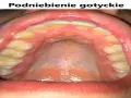 Widok jamy ustnej z zębami i podniebieniem. Charakterystyczne, ząbkowane linie dziąseł tworzą podniebienie gotyckie.