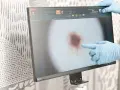 Dłoń w niebieskiej rękawiczce wskazuje na powiększone znamię na ekranie dermatoskopu.