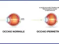 Confronto tra occhio normale e occhio ipermetrope: in quest'ultimo, il bulbo corto fa sì che l'oggetto vicino si veda sfocato.