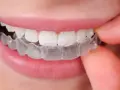 Jak naprawdę wygląda aparat na zęby? Od metalu po niewidoczne