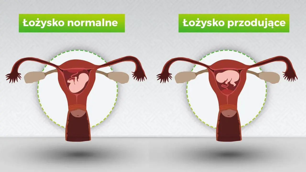 Porównanie: łożysko normalne vs łożysko przodujące. Po prawej stronie widoczna macica z płodem i łożyskiem przodującym, blokującym szyjkę macicy.