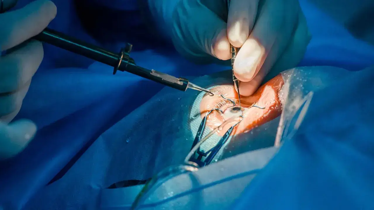 Dettaglio di un intervento glaucoma con tubicino, mani guantate usano strumenti chirurgici sull'occhio.