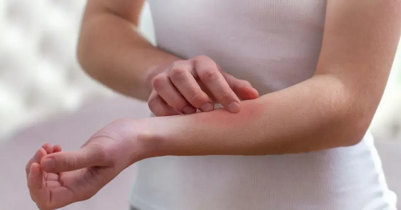 Dłoń drapiąca zaczerwienioną skórę na przedramieniu, objaw mogący wskazywać na lupus.
