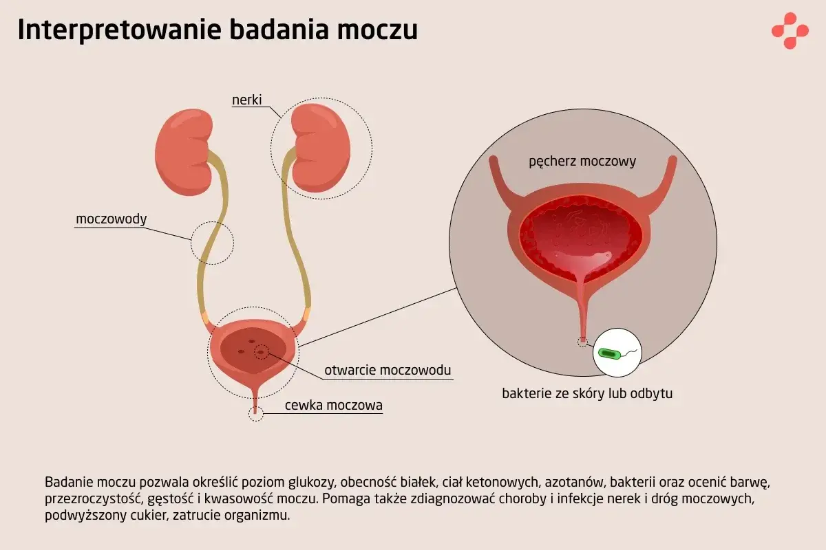Ilustracja układu moczowego z zaznaczonymi nerkami, moczowodami i pęcherzem. W powiększeniu widoczne bakterie w moczu.