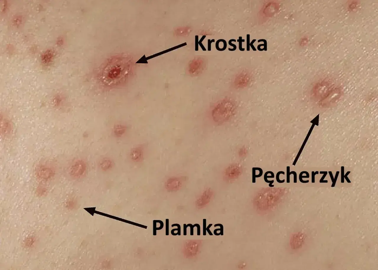Początki ospy: czerwone plamki, krostki i pęcherzyki na skórze.
