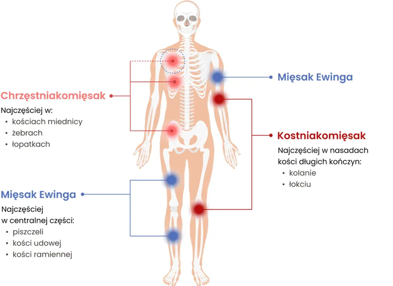 Schemat przedstawia lokalizację mięsaków: chrzęstniakomięsaka w miednicy, żebrach i łopatkach, a mięsaka Ewinga w piszczeli, kości udowej i ramiennej.