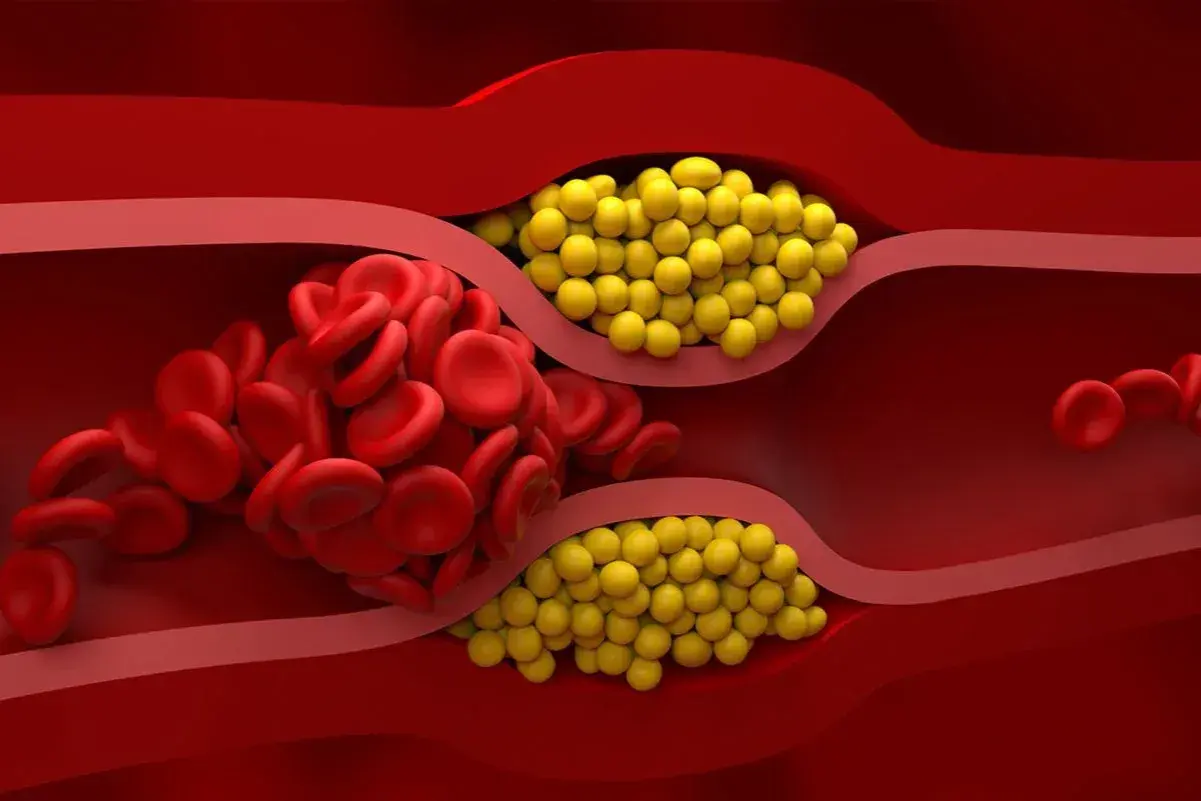 Zator w naczyniu krwionośnym: czerwone krwinki i żółte złogi. Badanie lipoproteiny pomoże ocenić ryzyko.