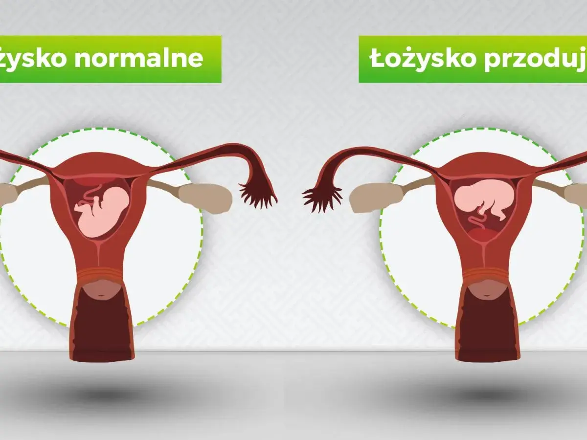 Porównanie: łożysko normalne vs łożysko przodujące. Na obrazku widać macicę z płodem. W przypadku łożyska przodującego, łożysko znajduje się na przedniej ścianie macicy.
