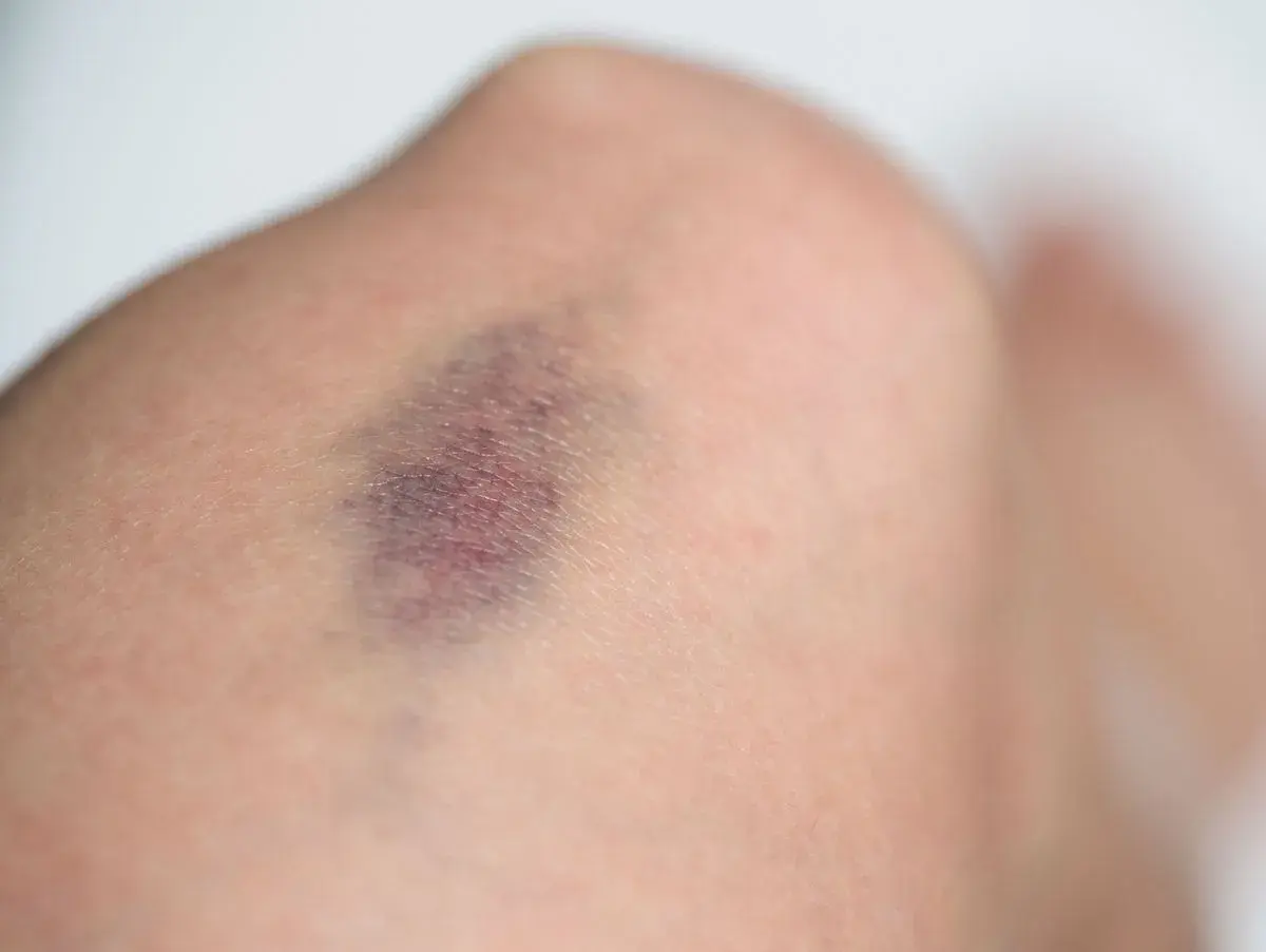 Nahaufnahme eines blauen Flecks am Bein, der auf eine mögliche Thrombose hindeutet.