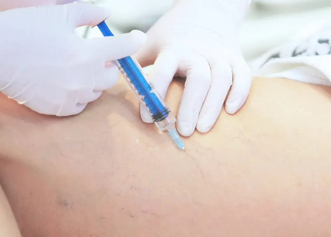 Lekarz w białej rękawiczce wykonuje zastrzyk strzykawką w nogę z widocznymi naczynkami. To skleroterapia żylaków opinie.