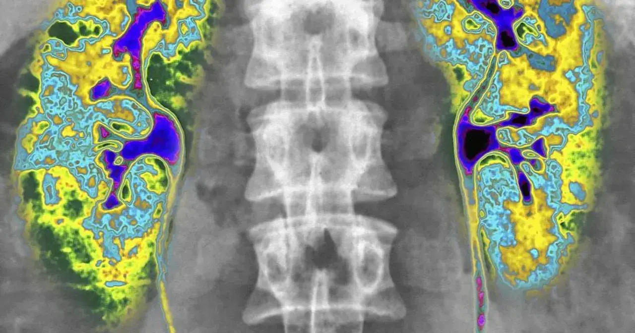 Kolorowa scyntygrafia kości pokazuje kręgosłup i obszary o zwiększonej aktywności metabolicznej, sugerujące potencjalne problemy.