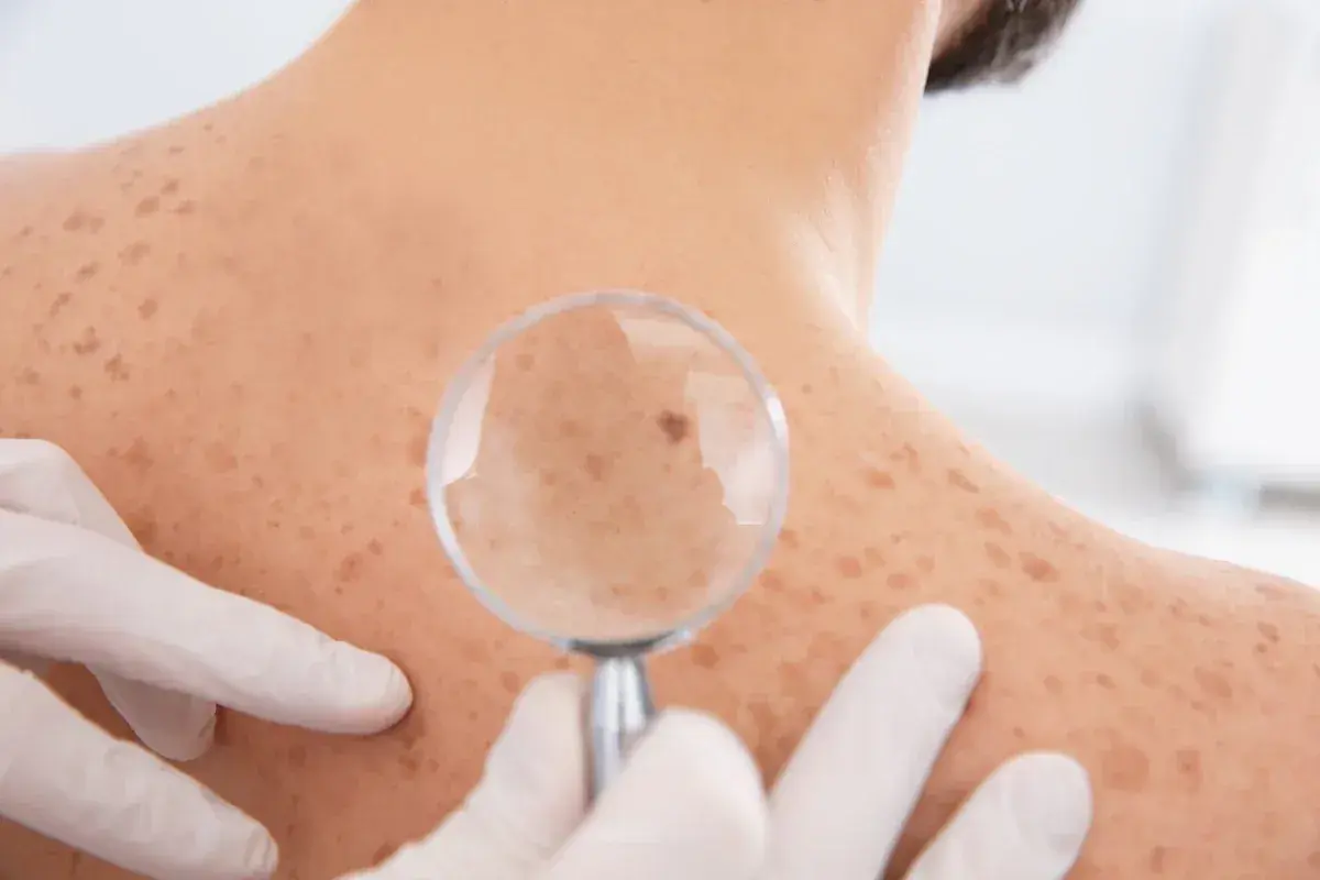 Dermatolog bada znamię na plecach pacjenta przez lupę. Skóra pokryta jest licznymi piegami i znamionami.