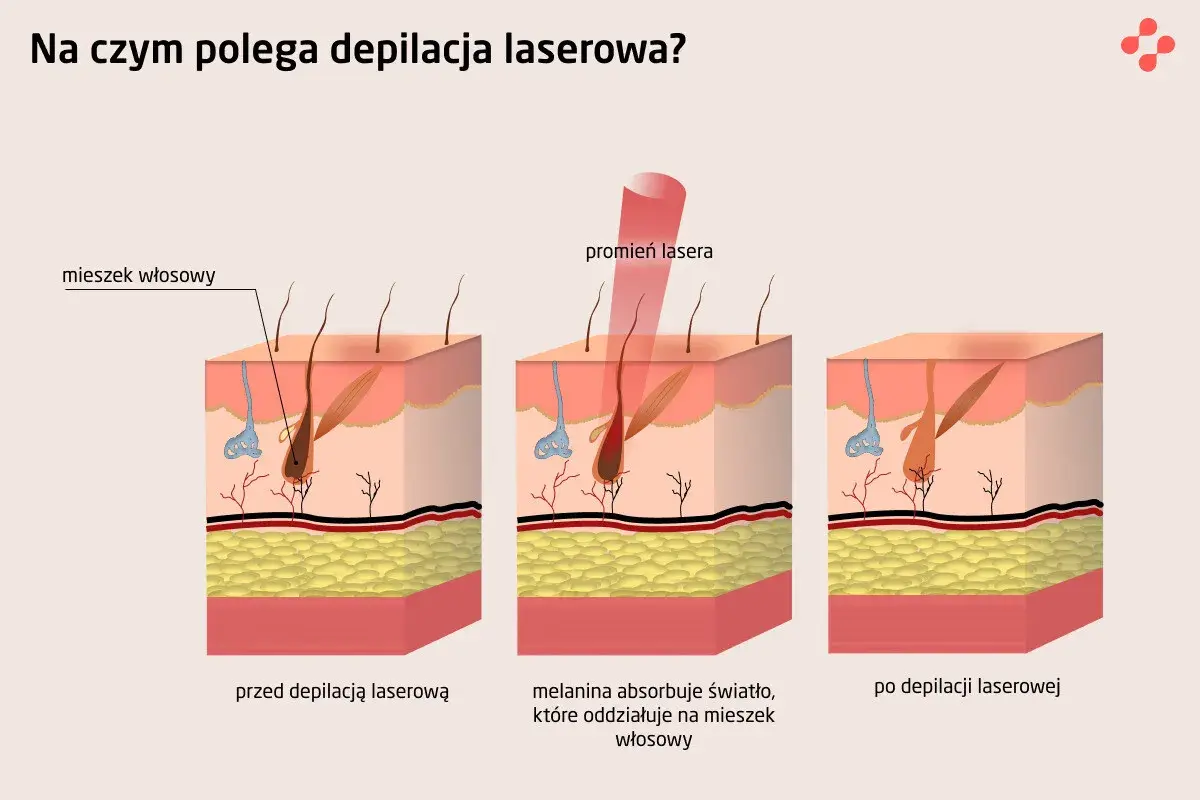 Ilustracja pokazuje, jak działa depilacja laserowa. Czy depilacja laserowa jest bezpieczna? Laser celuje w melaninę we włosie, niszcząc go.