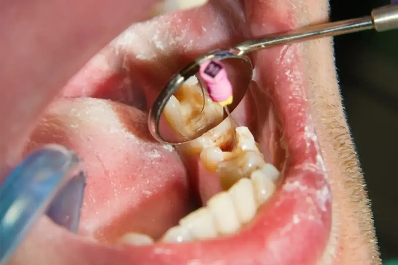 Zabieg stomatologiczny: martwy ząb jedynka w trakcie leczenia kanałowego. Widoczny instrument i lusterko dentystyczne.