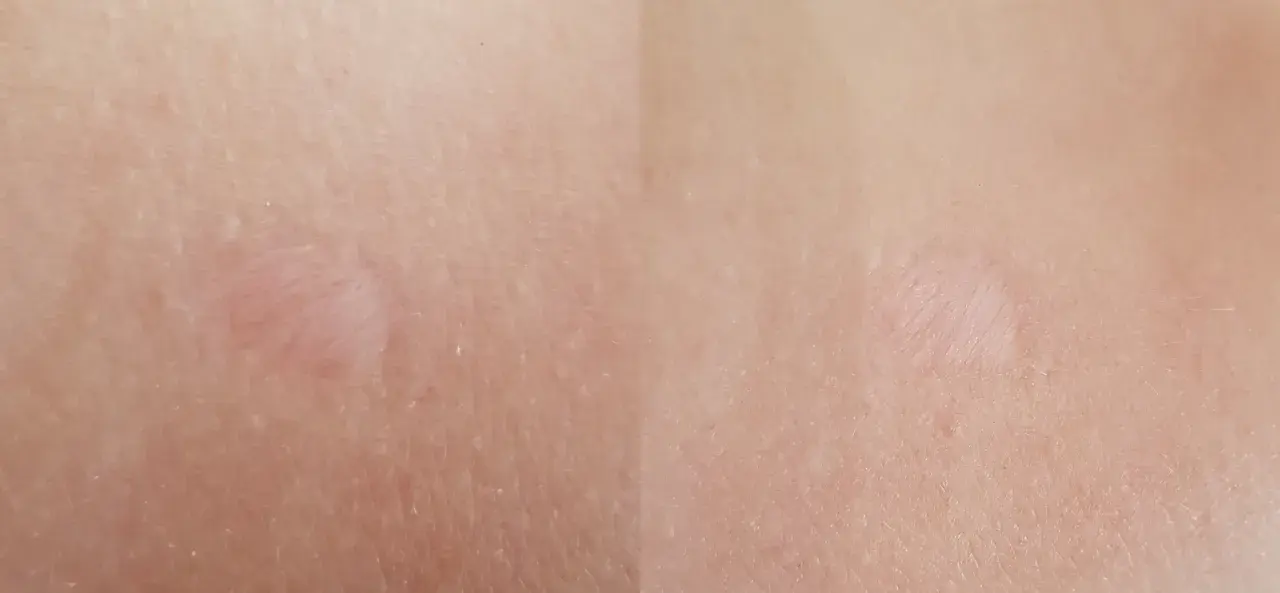 Jasna skóra z widocznymi, lekko zaróżowionymi bliznami po depilacji laserowej.