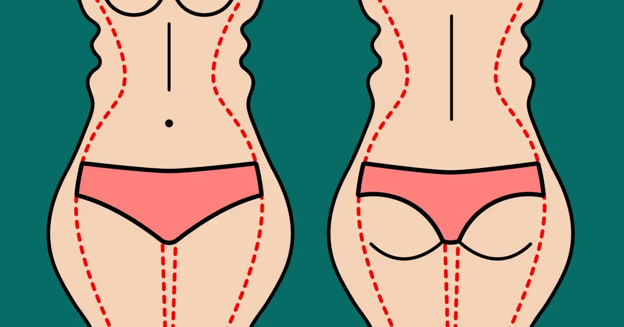 Ilustracja pokazuje sylwetkę przed i po zabiegu liposukcji ud. Czerwone linie zaznaczają obszary do modelowania.