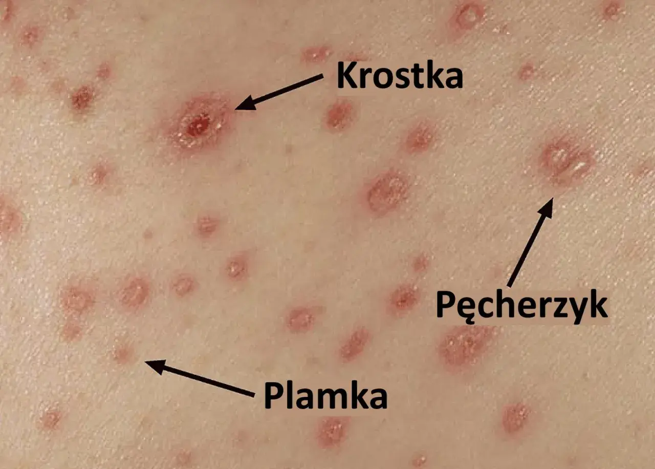 Skóra z licznymi zmianami: plamkami, krostkami i pęcherzykami, typowymi objawami ospy wietrznej.