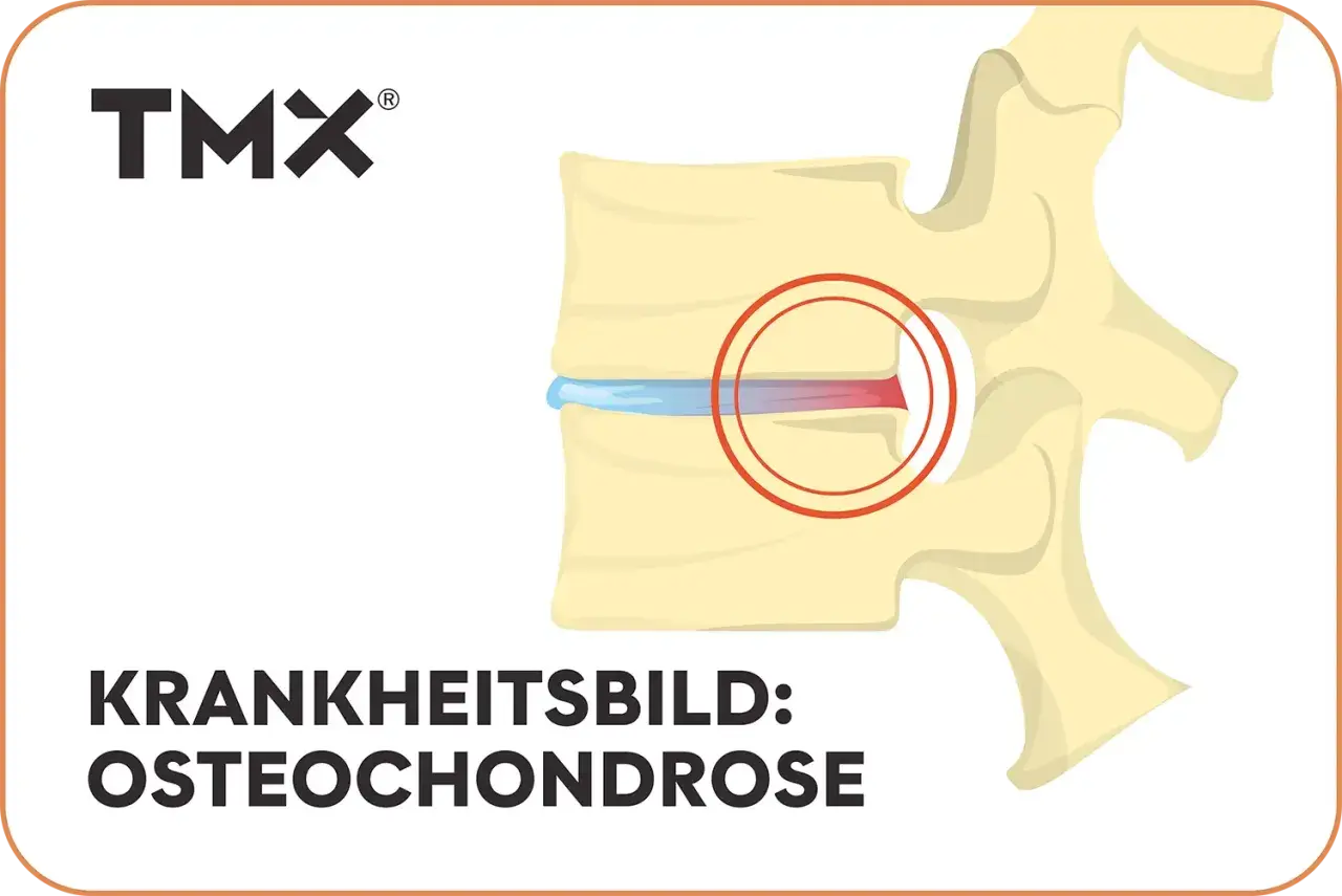 Darstellung eines Wirbels mit Bandscheibenschaden. Bei Osteochondrose wie geht es weiter? TMX Logo.