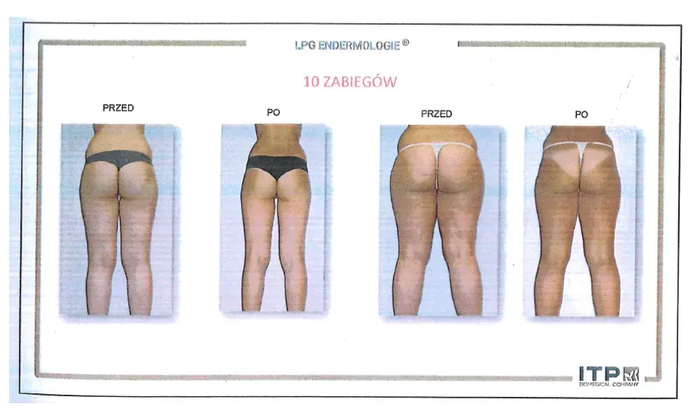 Endermologia: Jak często, ile zabiegów? Ekspert radzi!