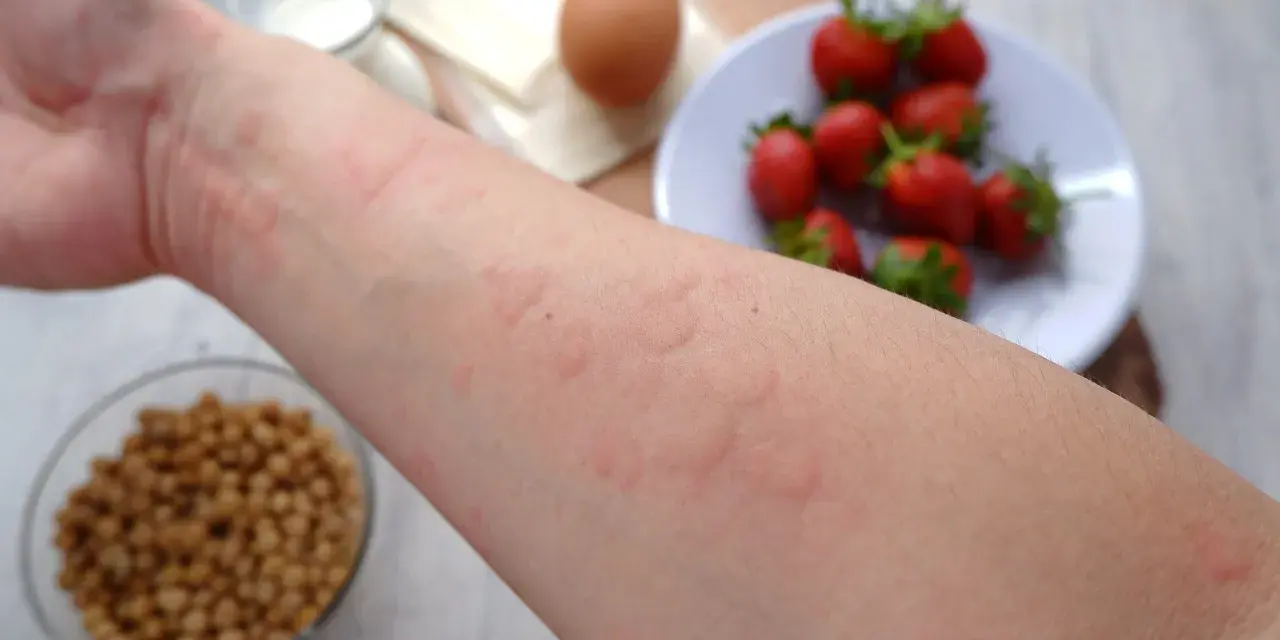 Ręka z wysypką, objawem alergii pokarmowej. W tle truskawki, jajko i nasiona.